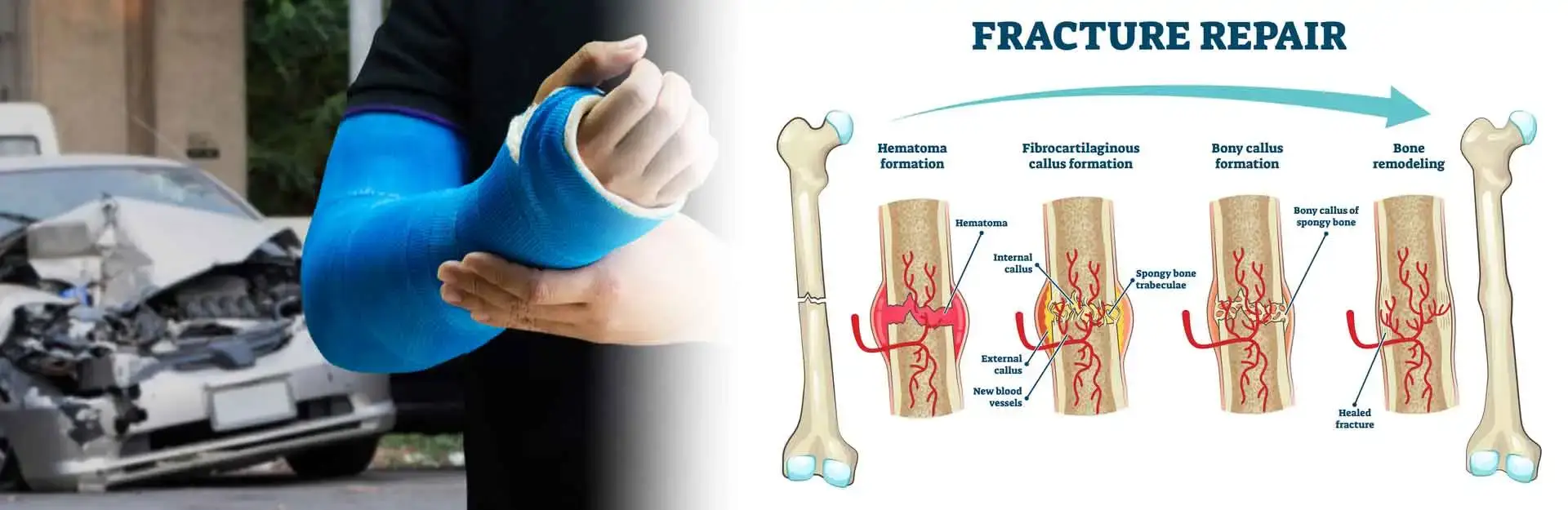 Bone Fracture Surgery in Kapurthala