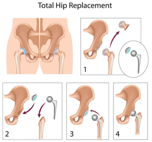 hip replacement surgery in ferozpur