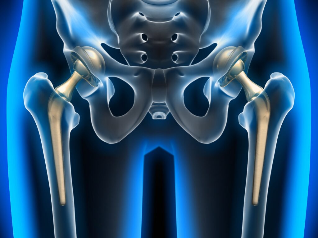 Hip replacement surgery in fazilka